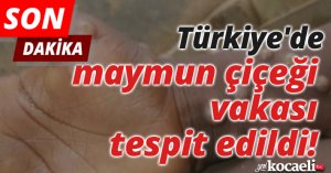 Türkiye'de ilk maymun çiçeği vakası tespit edildi