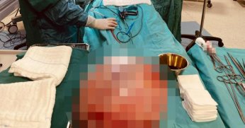 Hamile olduğunu sanıyordu, karnından 15 kilo kist çıktı