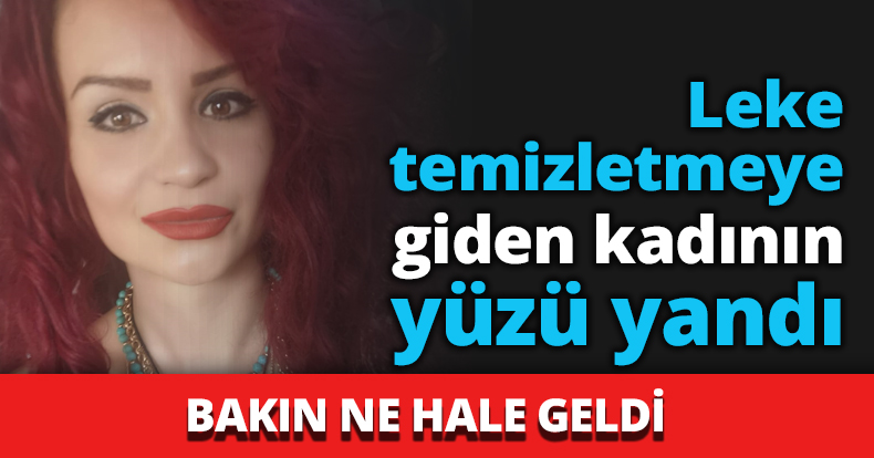 Leke temizletmeye gitti yüzü yandı