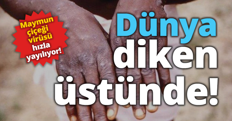 Dünya diken üstünde! Maymun çiçeği virüsü hızla yayılıyor