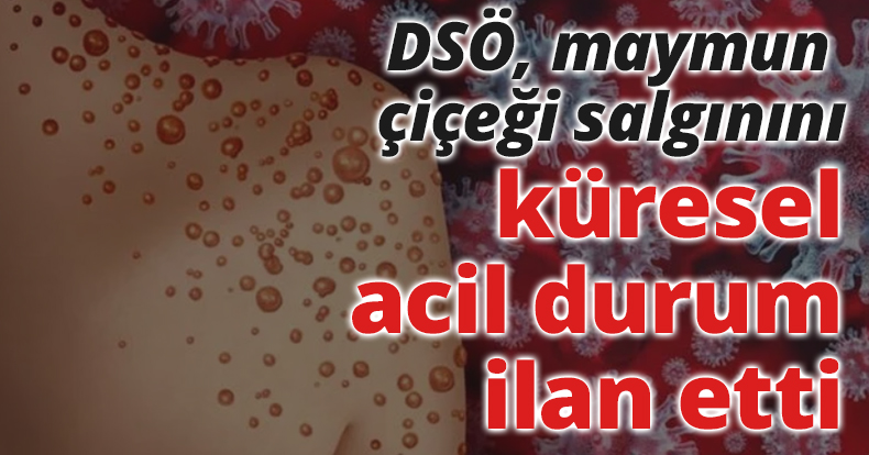 DSÖ, maymun çiçeği salgınını küresel acil durum ilan etti
