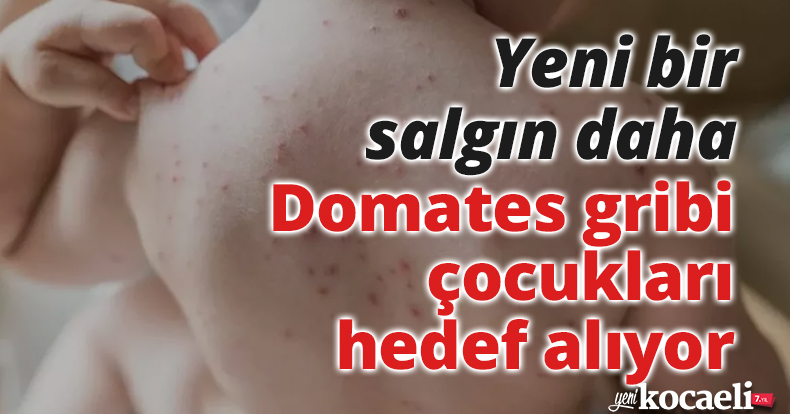 Yeni bir salgın daha: Domates gribi çocukları hedef alıyor 