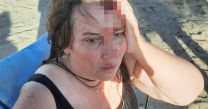 Denizde yüzerken jet ski çarptı, ölümden döndü